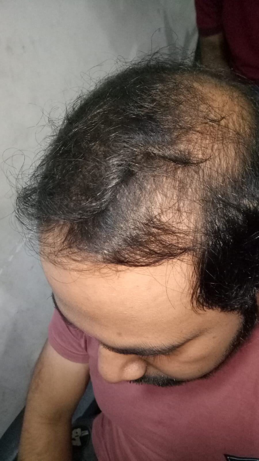 Before Hair Transformation